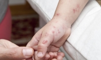 Aumentan casos de varicela en Yucatán