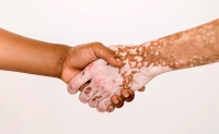 Entre 2 y 6% de los mexicanos padece vitiligo